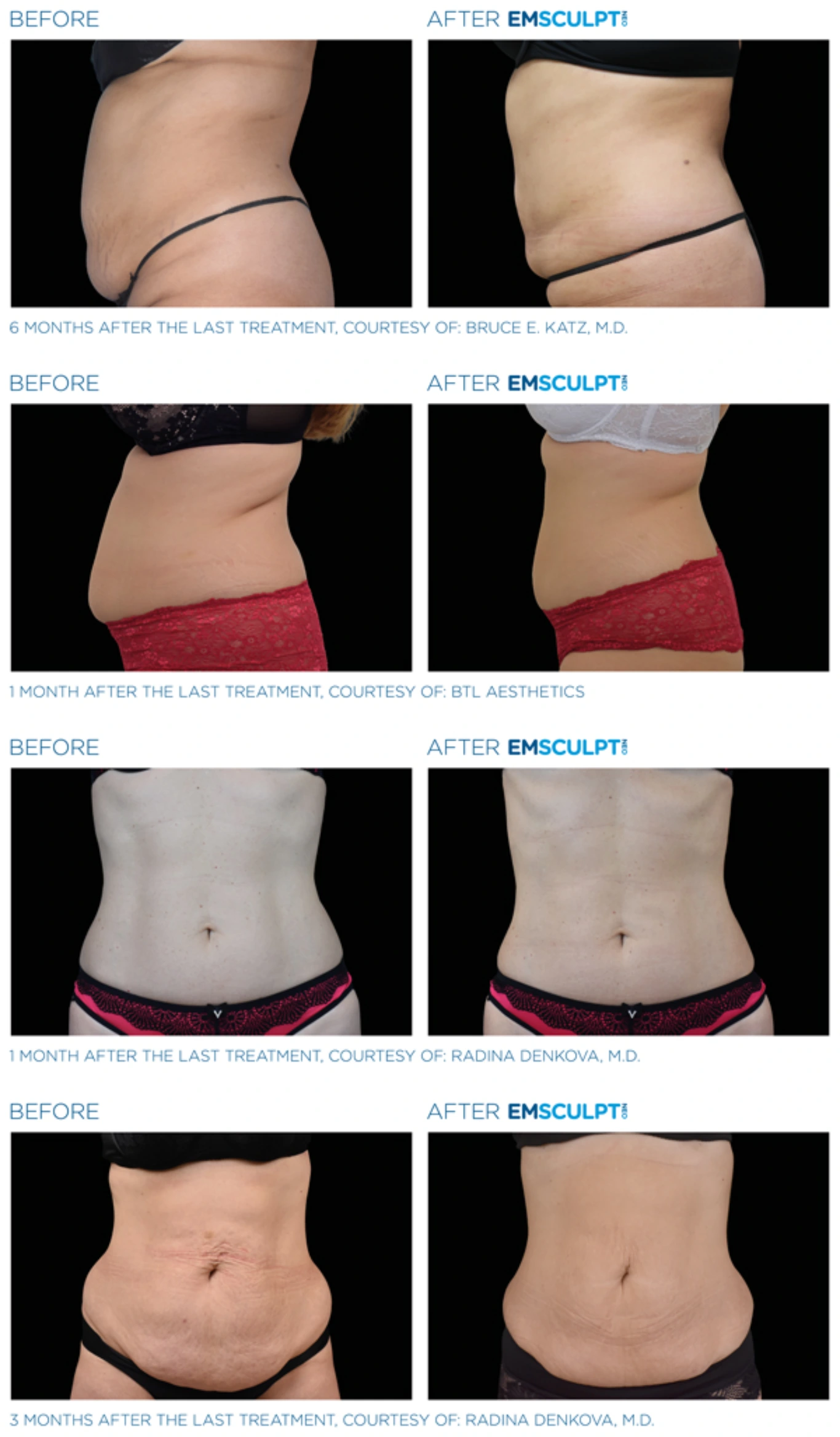 EMSCULPT NEO Before & Afters Before and after images showing abdomen fat reduction and muscle toning with EMSCULPT treatment